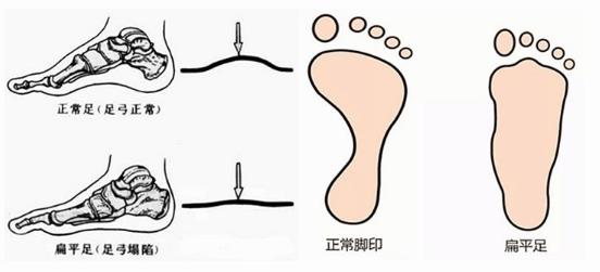 扁平足能跑步嗎？扁平足跑步有什么危害？