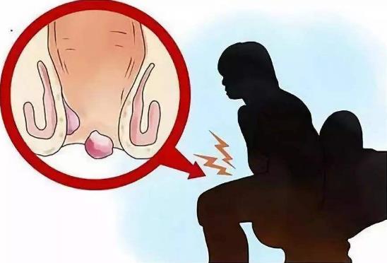 痔瘡是怎么引起的？痔瘡的最佳簡單預(yù)防方法